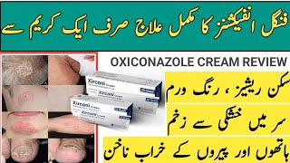 Xirconi cream uses in Urdu  oxiconazole nitrate 1 Benifits  xirconi cream  dosage sideeffects [upl. by Serles799]