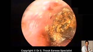 Earwax Removal Extraction Cholesteatoma Surgery Whole Video DrThouk Earwax Specialist [upl. by Llertrac]