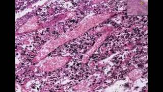 Histopathology Lymph nodeAnthracosis tuberculosis [upl. by Hampton]