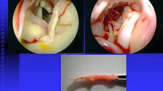 Stenoses aortiques et coarctation de laorte [upl. by Durstin]