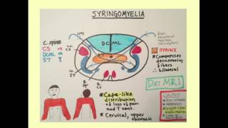 Syringomyelia  CRASH Medical Review Series [upl. by Tinor]