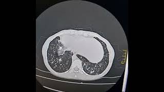 KartagenerAfzelius syndrome a subset of Primary ciliary dyskinesia [upl. by Yared242]