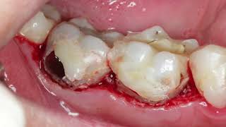 Waterlase Gingivectomy to expose class V cavity [upl. by Also]