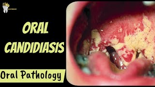 ORAL CANDIDIASIS  Diagnosis and Management  Oral Pathology [upl. by Allehcram]