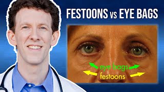 What Are Eye Festoons vs Lower Eyelid Bags [upl. by Dixon]