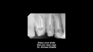 Upper posterior endodontic rehabilitation [upl. by Sharron699]