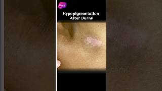 Hypopigmentation After Burn burnscar lasertreatment skintreatment shorts youtubeshorts [upl. by Bathulda]