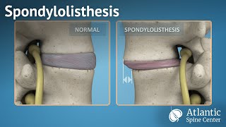 Spondylolisthesis [upl. by Ennaed]