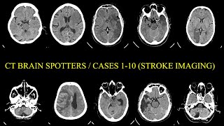 Stroke Imaging CT Brain Cases [upl. by Rives776]