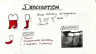 dilaceration dental  dilaceration  Developmental Disturbance of Teeth [upl. by Boutis197]