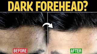 How To Get Rid of Dark Forehead Proven Solution  Forehead Black Removal [upl. by Ellimahs751]