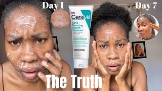 I TRIED CeraVe Acne Foaming Cream Cleanser for a week 7 days and This Happened [upl. by Lovell]