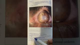 hsv keratitis  stromal keratitis  necrotic and disciform keratitis  cornea part 9 [upl. by Russ]