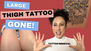 Large Thigh Tattoo Removal Pt 2 [upl. by Inod]