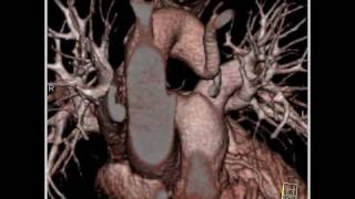 Cardiac Compression of trachea by right aortic arch with attempted double aortic arch 3 of 5 [upl. by Happy189]