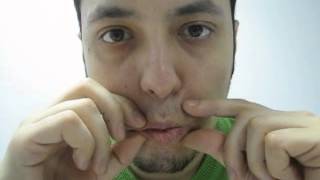 FACIAL PARESIS EXERCISE 6 AFTER ACOUSTIC NEUROMA SURGERY [upl. by Mercy]