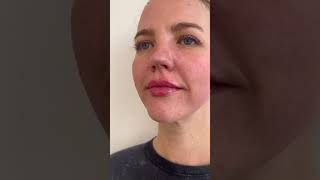 My Lip Filler Experience Real Results aobmedspa medspa [upl. by Anelah]