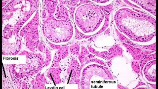 Atrophy Testes [upl. by Ierna]