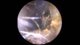 Gentle ear wax removal with Jobson Horne Probe [upl. by Ruel]