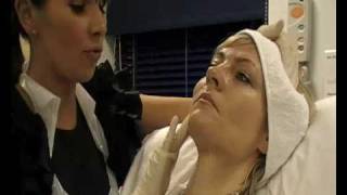 Skin Rejuvenation  Sculptra injections live demonstration [upl. by Ibrad]