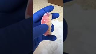 Immediate Denture Soft Reline [upl. by Medwin484]