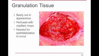 WoundRounds Free Webinar  PUSH Tool for Monitoring Pressure Ulcer Healing A Practical Guide [upl. by Lennod]