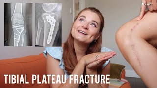 6 MONTH UPDATE  Tibial Plateau Fracture ORIF Surgery Recovery [upl. by Doxia313]