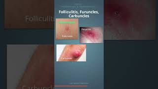 Folliculitis Furuncles and Carbuncles  Do you know the difference shorts [upl. by Inot]