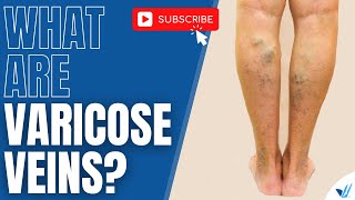 What Are Varicose Veins [upl. by Wickman360]