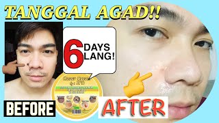 KASOY CREAM MURA AT MABISANG PANGTANGGAL NG NUNALStep by Step Procedure on How To Remove Your MOLE [upl. by Nylaret]