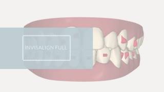 Invisalign Full ClinCheck  Invisalign casos difíciles [upl. by Edie697]