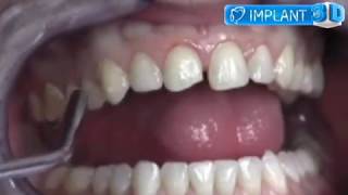 Fatete dentare la Implant3D Fixpeloc [upl. by Larissa]