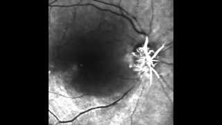 Central Retinal Artery Occlusion [upl. by Teirrah297]