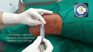 Prepatellar Septic Bursitis  Bursa Aspiration  Impending septic arthritis knee  Adamya Hosp Vid [upl. by Goat]