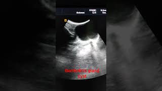 Bartholins gland cyst [upl. by Reeva331]