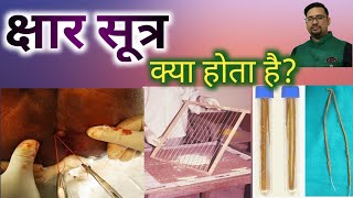 Kshar Sutra  Treatment of piles and Fistula  kshar sutra surgury क्षार सूत्र क्या होता है [upl. by Hna]