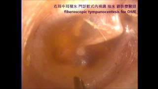 右耳中耳積水 門診軟式光纖內視鏡抽水 Fiberscopic tympanocentesis for right OME Dr KenLiao Liu [upl. by Parent436]