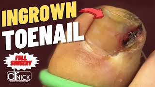 Extreme Closeup Ingrown Toenail Removal  Dr Nick Campitelli [upl. by Salaidh]