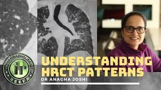 Understanding Lung HRCT patterns  Dr Anagha Joshi  Nodules amp Septal Thickening [upl. by Artur]