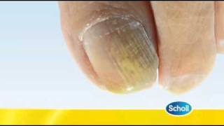 Fungal Nail Condition by Scholl [upl. by Kramlich]