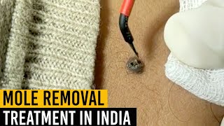 Mole Removal Treatment in India  RF Cautery Treatment  Je Amour India [upl. by Aneekan647]