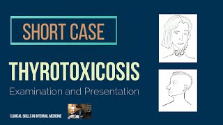 Thyrotoxicosis  Short Case [upl. by Ttocserp]