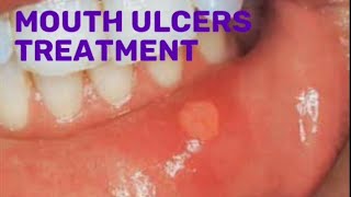 Drugs for mouth ulcers treatment pharmacist pharmacy [upl. by Creamer]