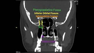 Coronal CT anatomy of Foramen Rotundum and Pterygopalatine Fossa [upl. by Winthorpe]