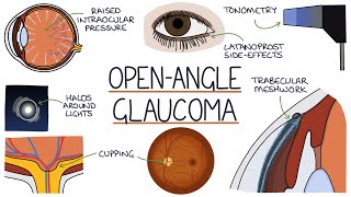 Understanding Open Angle Glaucoma [upl. by Novart]