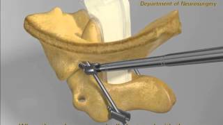 Posterior Reduction of Atlantoaxial Dislocation and Basilar Invagination [upl. by Drescher]