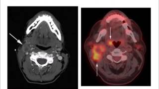 HPV and Oropharynx Cancer [upl. by Anidan]