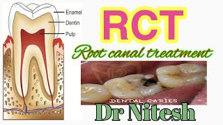 Root canal Treatment RCT Step by Step Animation [upl. by Buerger428]