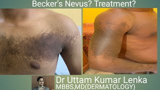 Becker’s Nevus It’s treatment Achanak pith me hone wala black spot [upl. by Acnairb]