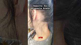 Alopecia Areata Treatment Houston Trichologist alopecia hairloss [upl. by Enoved458]